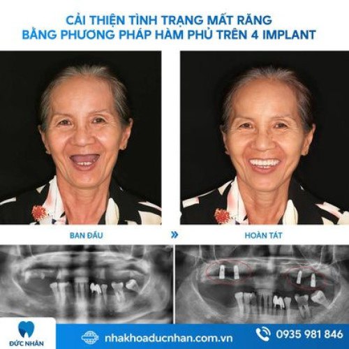 TRỒNG RĂNG IMPLANT