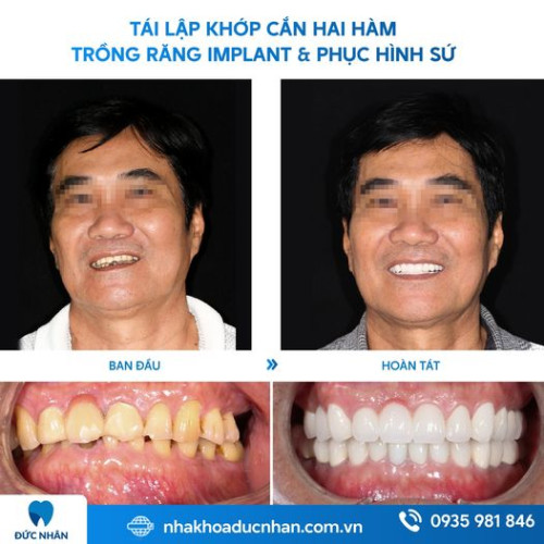 TRỒNG RĂNG IMPLANT