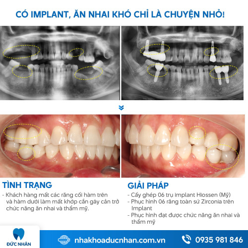 TRỒNG RĂNG IMPLANT