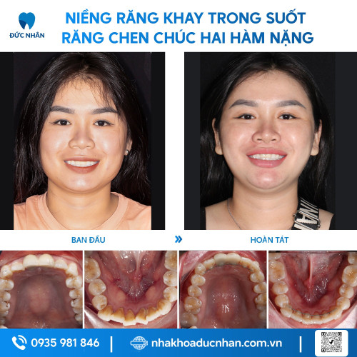 NIỀNG RĂNG TRONG SUỐT