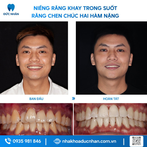 NIỀNG RĂNG TRONG SUỐT