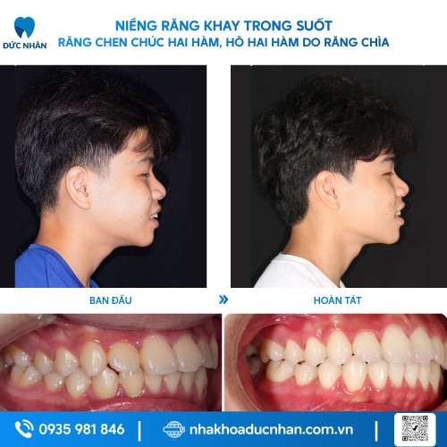 NIỀNG RĂNG TRONG SUỐT