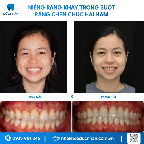 NIỀNG RĂNG TRONG SUỐT