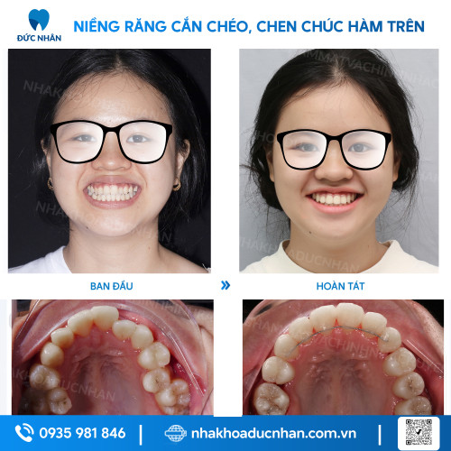 NIỀNG RĂNG MẮC CÀI