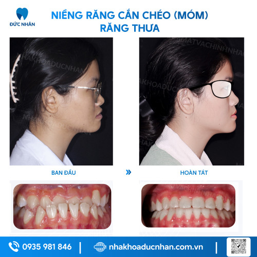 NIỀNG RĂNG MẮC CÀI