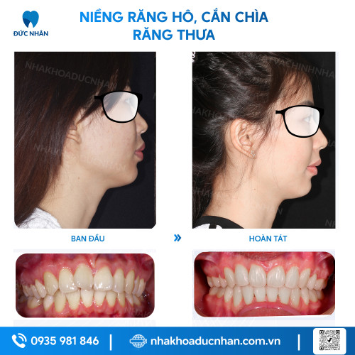 NIỀNG RĂNG MẮC CÀI