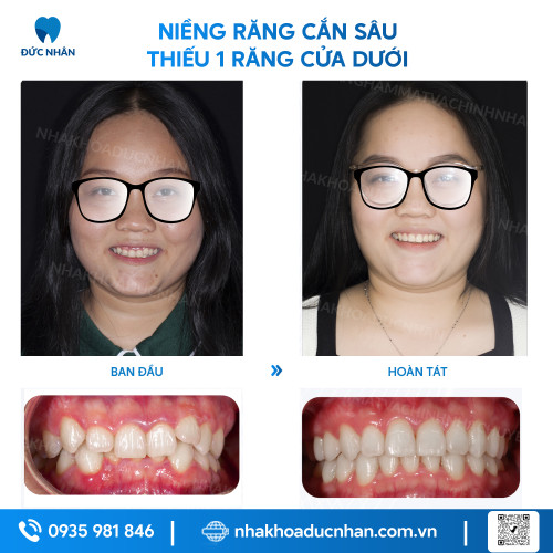 NIỀNG RĂNG MẮC CÀI