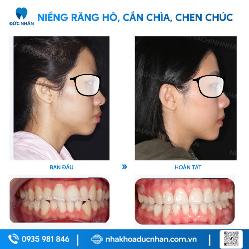 NIỀNG RĂNG MẮC CÀI