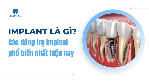 Implant là gì? Các dòng trụ Implant phổ biến nhất hiện nay